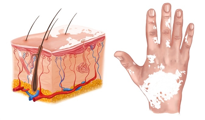 Illustration of vitiligo - Image Credit: corbac40